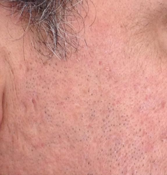 Anna-Baker-Aesthetics-Medical-Micro-needling-After
