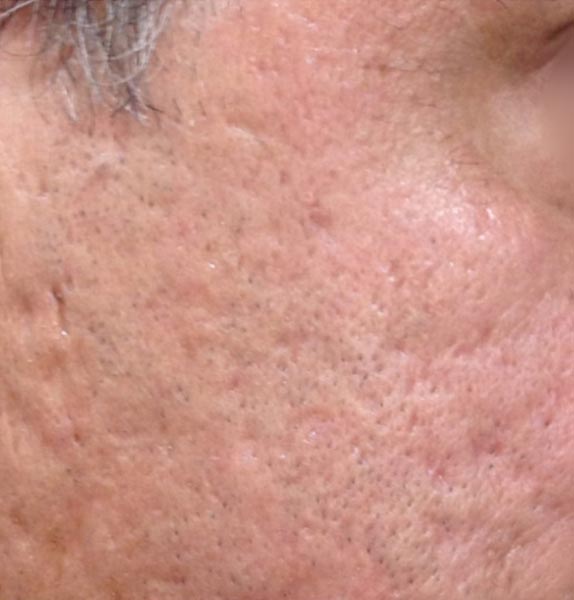 Anna-Baker-Aesthetics-Medical-Micro-needling-Before Anna-Baker-Aesthetics-Medical-Micro-needling-Before