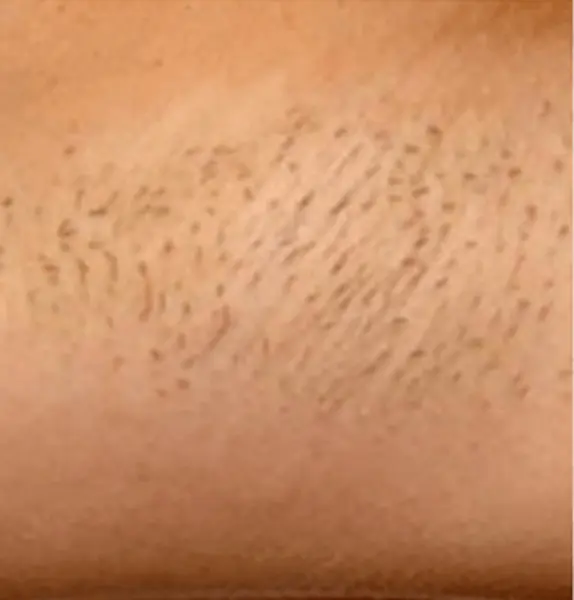 Hair-Removal-Before2-574x600.jpg